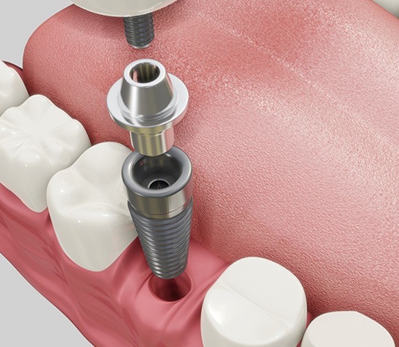 Digital image how dental implants work in Frankfort