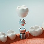 Digital image of the dental implant parts