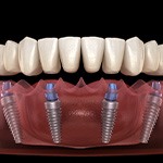 Digital image of a custom implant denture