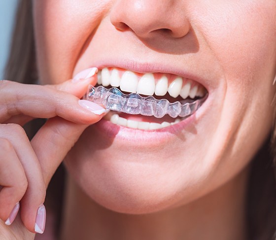 Woman reinserting her removable clear aligner