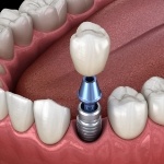 Illustration of single dental implant and crown