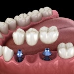 Illustration of two dental implants and bridge
