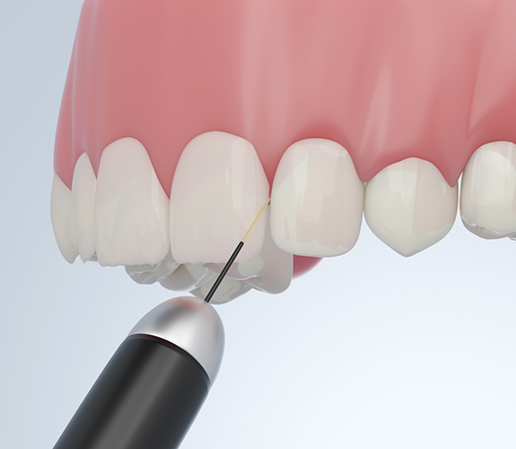 Illustration of gums being treated with soft tissue laser
