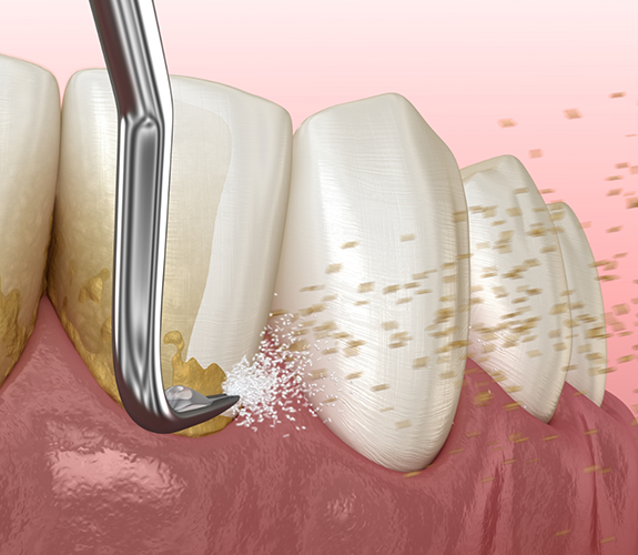 Illustration of scaling and root planing for lower arch