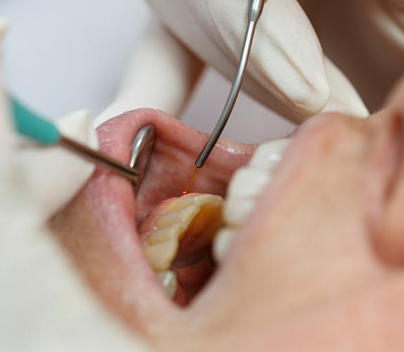 Soft tissue laser treatment for lower arch