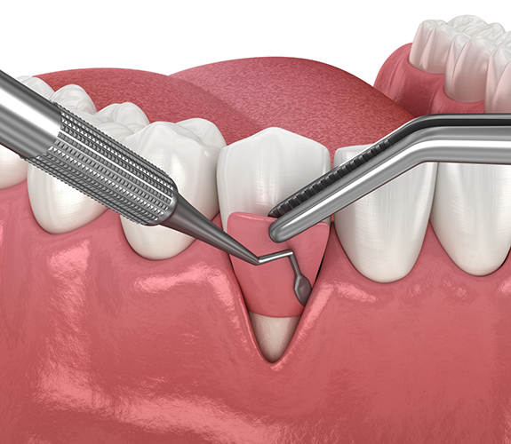 Illustration of a gum graft