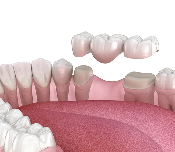 Illustration of dental bridge being attached to natural teeth