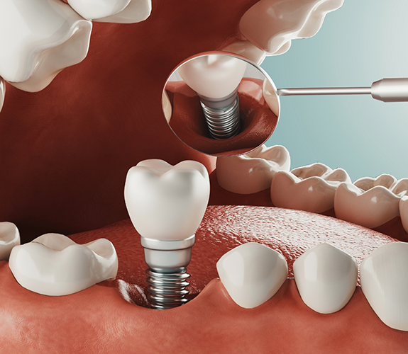 Illustration of dental implant in lower jaw being examined by a dental mirror