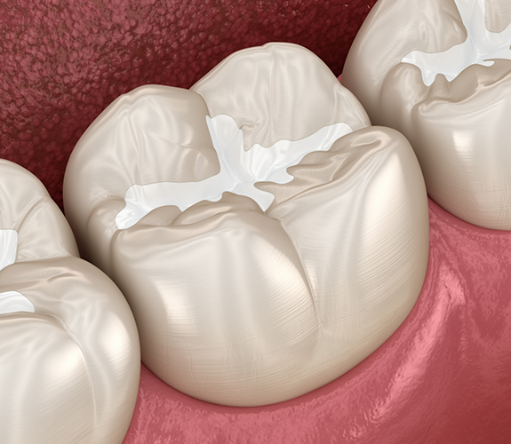 Illustration of tooth with tooth-colored filling