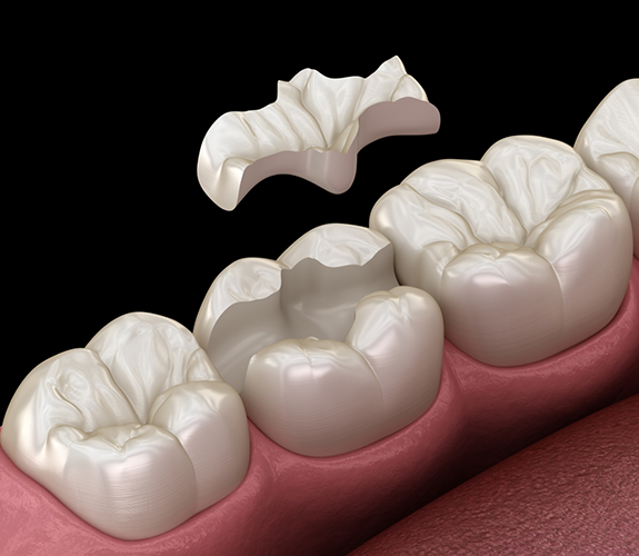 Illustration of inlay being applied to tooth