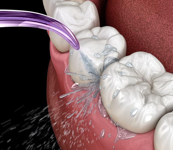 Illustration of teeth being cleaned with water