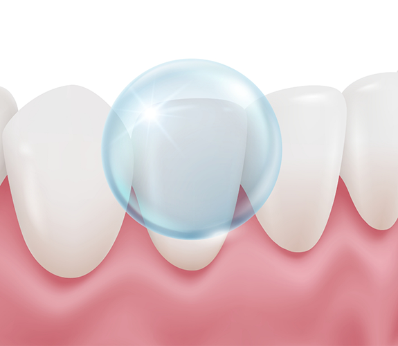 Illustration of fluoride applied to a tooth