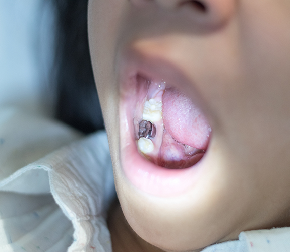 Opening mouth to show tooth with sealant