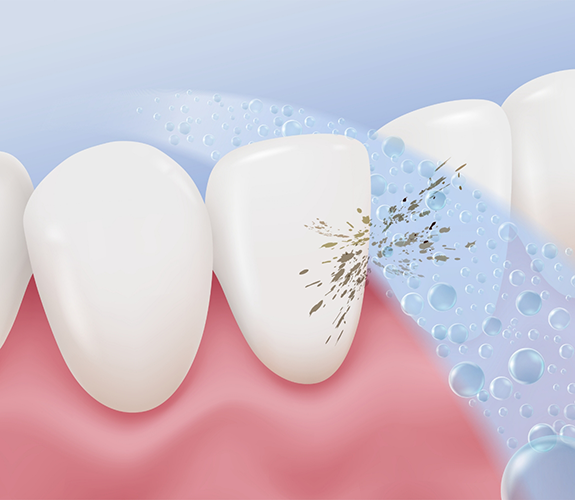 Illustration of stream of fluoride applied to tooth
