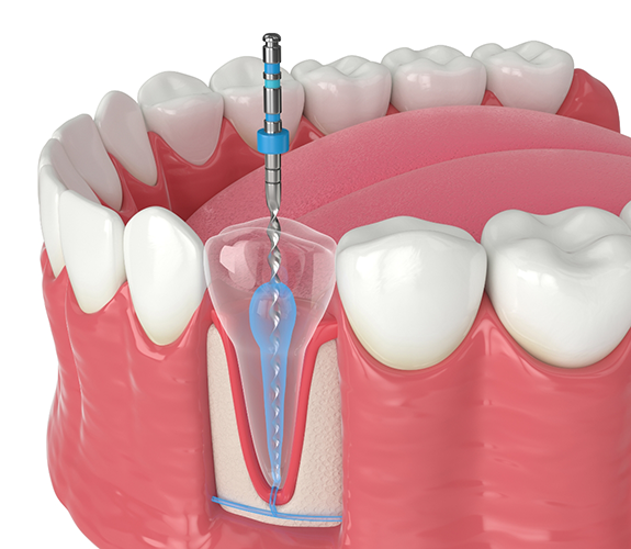 Illustration of pulp therapy performed on lower tooth