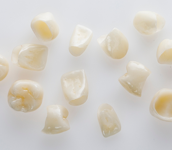 Multiple metal-free dental restorations