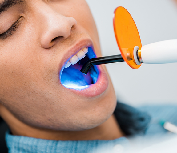 Performing cosmetic dental bonding on lower arch of teeth