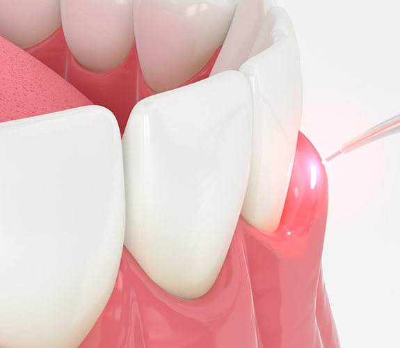 Using laser to perform gumm recontouring treatment