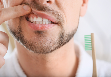 Man pulling up lips to show gums