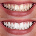 Factors that affect the cost of teeth whitening include how deep your stains are