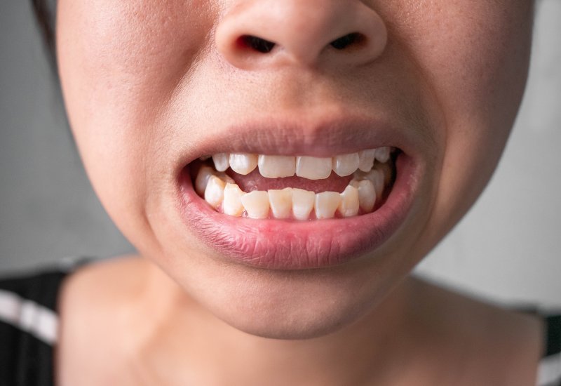 person with white spots on their teeth