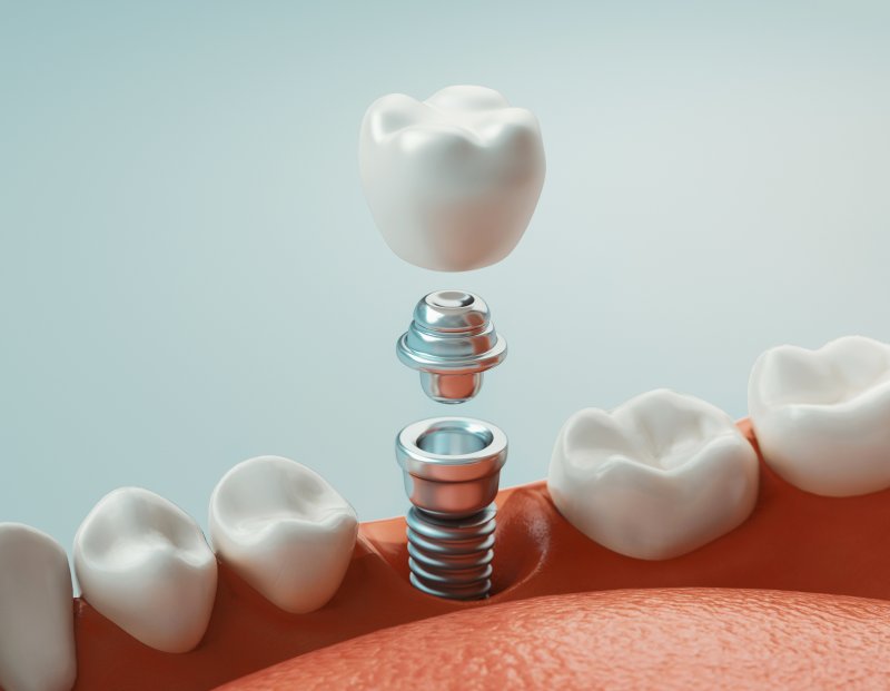 single dental implant